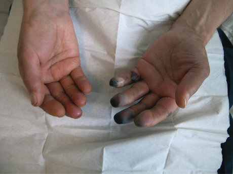 سرمازدگی-انگشت