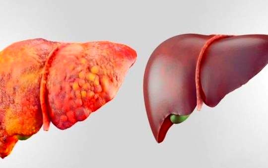 بیماری خطرناک کبد چرب با این علائم می آید
